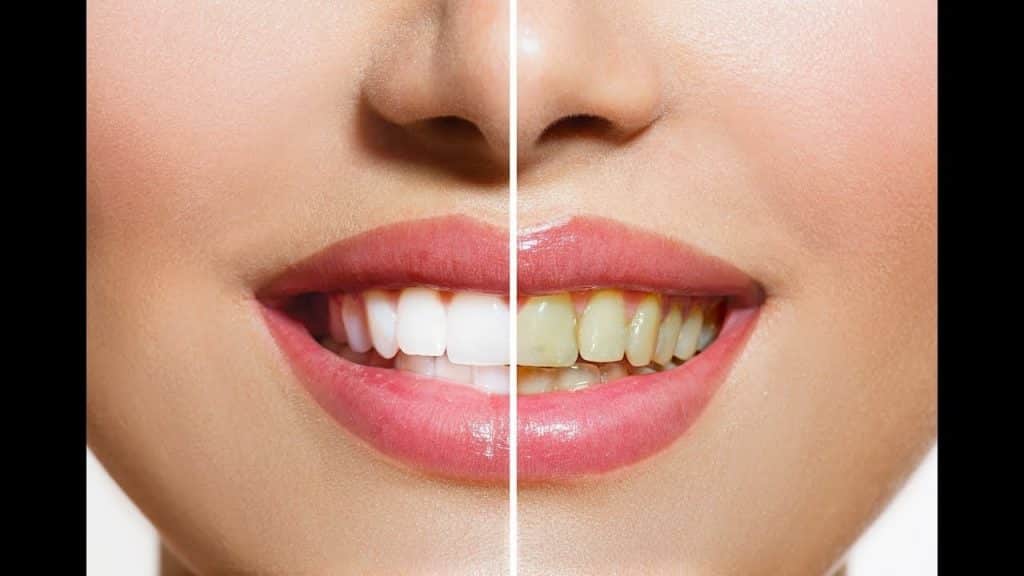Misturou estes três ingredientes e colocá-los em seus dentes Misturou estes três ingredientes e colocá-los em seus dentes